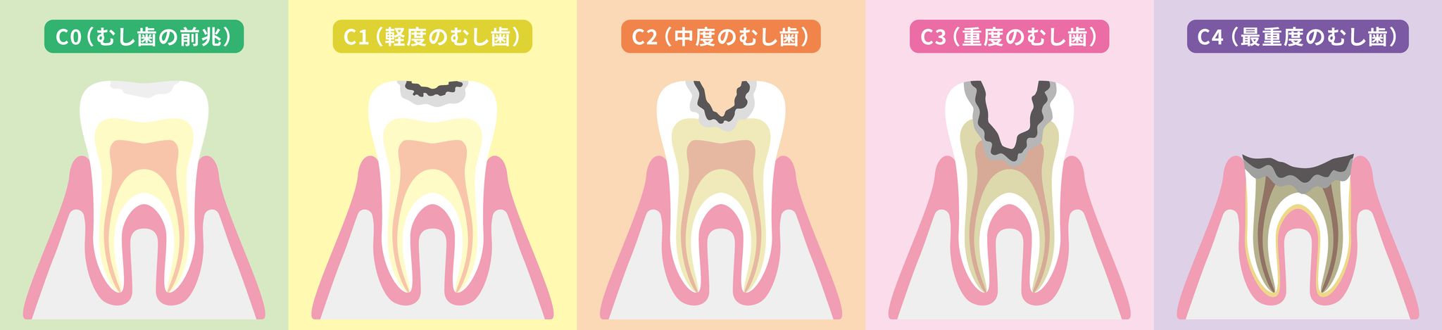 むし歯の進行と症状