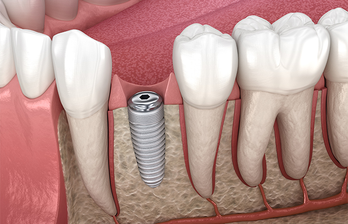 一次手術(フィクスチャーの埋込み)