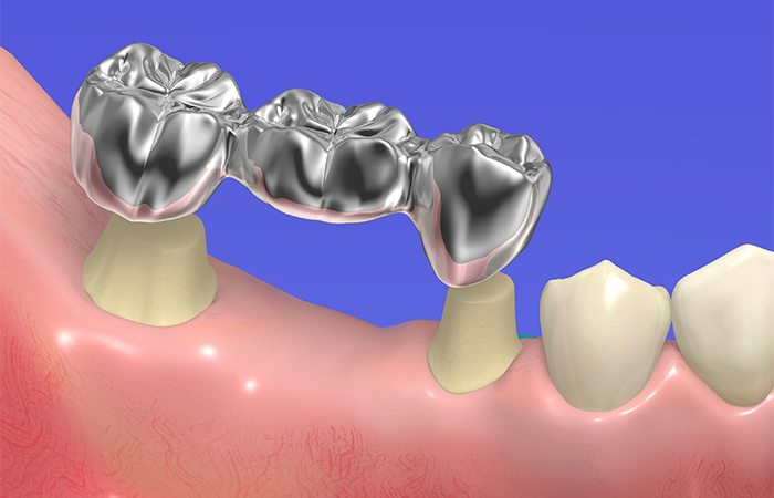 ブリッジとの違い