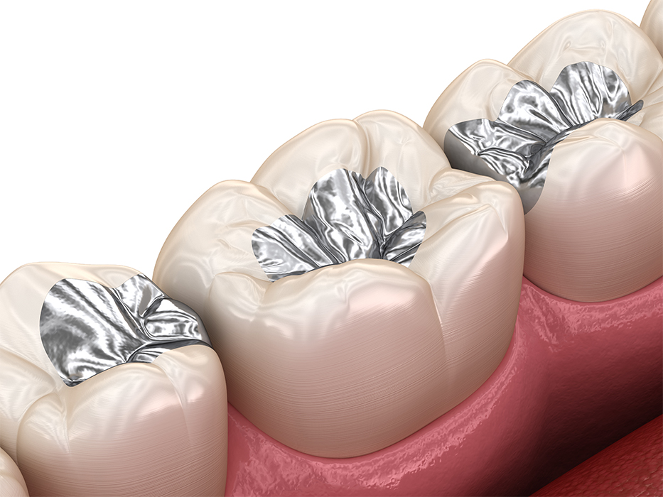 メタルインレー
