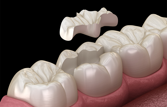 セラミックインレー