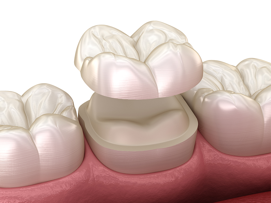 セラミッククラウン