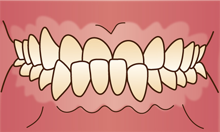 下顎前突(かがくぜんとつ)