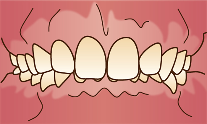 過蓋咬合(かがいこうごう)