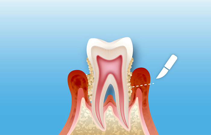 中度の歯周炎～重度の歯周炎の治療