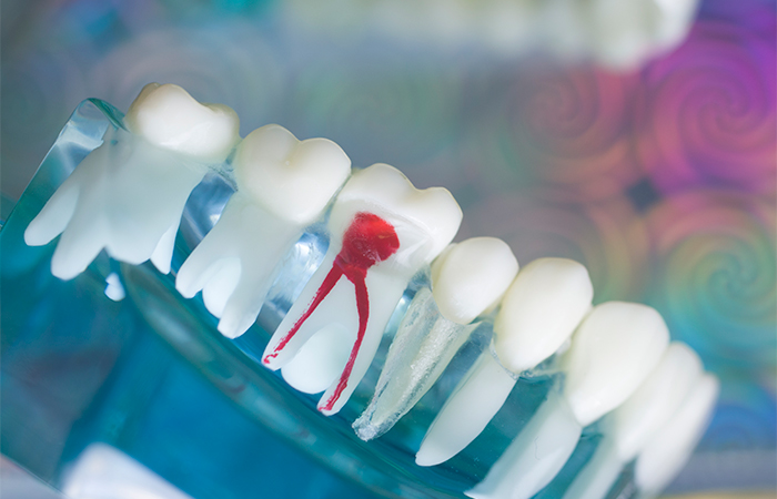 根管の充填を行い、被せ物をします