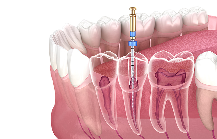 根管治療の流れ