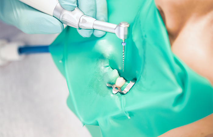 歯の神経を丁寧に除去します