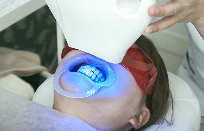 オフィスホワイトニング