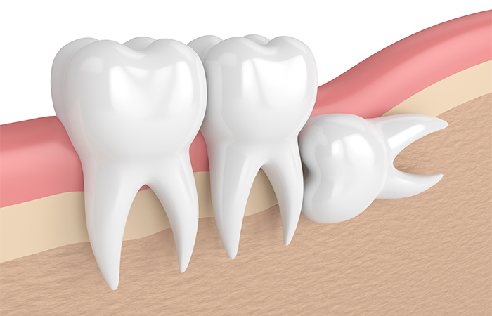 抜歯が必要な親知らずについて