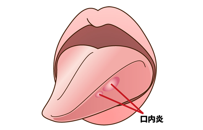 口腔粘膜の疾患の一例